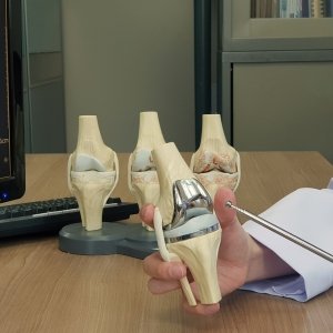 TOTAL KNEE REPLACEMENT 