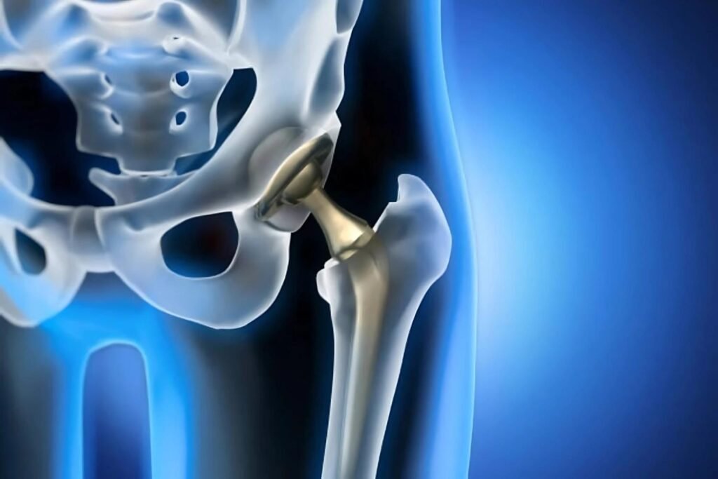 Partial Hip Replacement Photo
