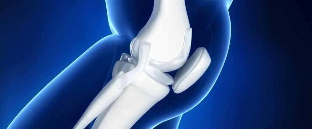 Knee Implant