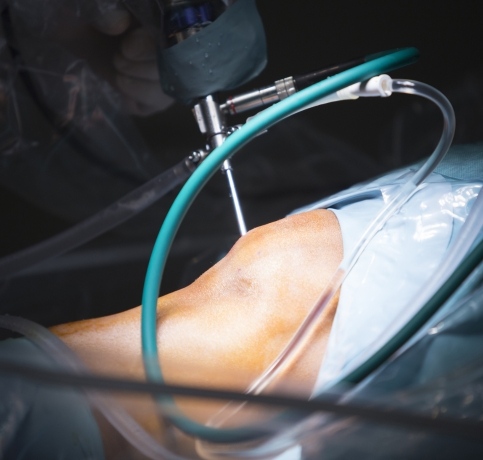 Arthroscopy